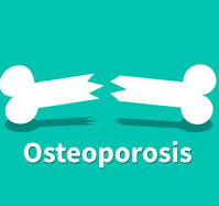 علائم پوکی استخوان علائم پوکی استخوان
